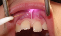 Laser diode dentaire Triangelaser 980 nm pour thérapie laser de faible intensité / photo-biomodulation / blanchiment des dents, appareil laser dentaire