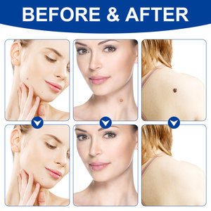 ELAIMEI Portable Large Size <strong>Skin</strong> <strong>Tag</strong> <strong>Removal</strong> Pen Kit Safe and Effective Auto <strong>Skin</strong> <strong>Tag</strong> Remover for Home Use - Product Image 4