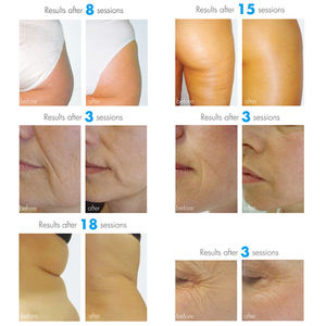 <span class=keywords><strong>SVATAR</strong></span> Micro Vibración Terapia Endoroller Masaje Corporal Drenaje Linfático Máquina de Eliminación de Celulitis - Product Image 6