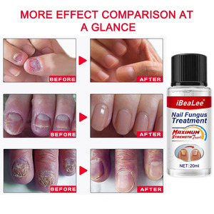 IBeaLee 20ml soluzione per la riparazione delle unghie clean whiten nourish nails trattamento fungino trattamento dei funghi delle unghie dei piedi - Product Image 2