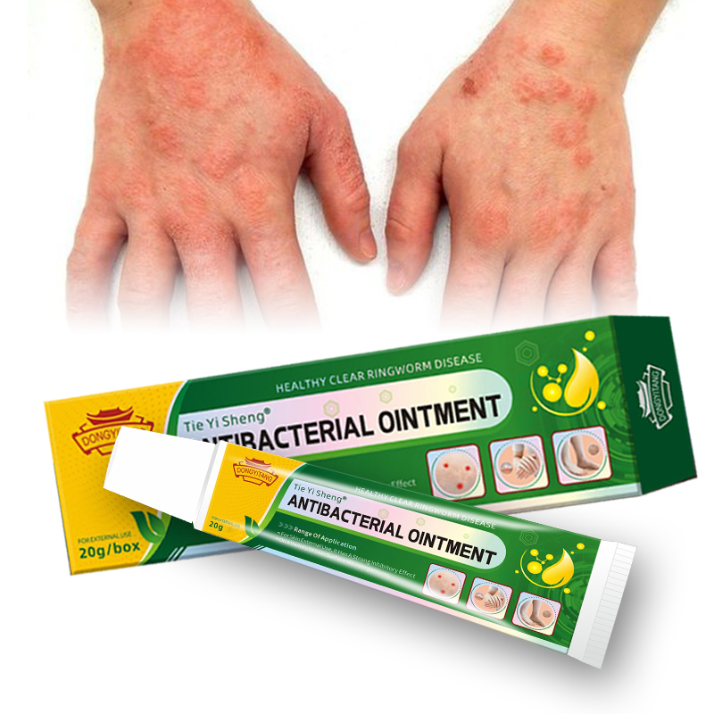 Chinese Herbal Eczema Cream Local Infection Acne Skin Itching Psoriasis Dermatitis Ointment