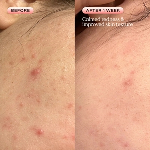 ETRUN ALISA Private Label Óleo Leve Breakout Balancing <span class=keywords><strong>Serum</strong></span> Reduzir Poros entupidos e Breakouts Manter a pele hidratada - Product Image 4
