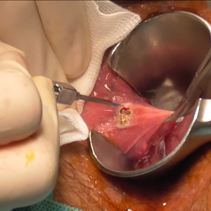 مصادقة CE الطبية ديود ليزر علاج البواسير آلة جراحة 980nm1470nm قطع البواسير/الناسور الشرجي - Product Image 6