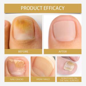 Spray Calmante para el Cuidado <span class=keywords><strong>de</strong></span> <span class=keywords><strong>la</strong></span> Piel <span class=keywords><strong>de</strong></span> Manos y Pies con Veneno <span class=keywords><strong>de</strong></span> Abeja <span class=keywords><strong>de</strong></span> 20 ml, para Uñas Dañadas, Aroma a Miel, OEM/ODM Personalizado-GOTDYA - Product Image 2