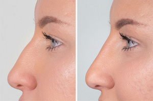 Vente en gros – Acide hyaluronique réticulé BDDE approuvé CE, non chirurgical, pour remodelage nasal et augmentation du <span class=keywords><strong>volume</strong></span> du nez - Product Image 4