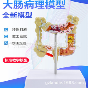 Modèle humain de petite maladie du côlon ; modèle de côlon en proctologie et gastroentérologie ; côlon en gastroentérologie ; intestin. - Product Image 3