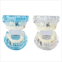 Modelo Dental de Puente de Restauración Dental con Dientes Removibles Estándar, Modelo de Resina para Implantes, Modelo de Tipodonto para Enfermedades Dentales, para Estudio de Ciencias Médicas y Odontología