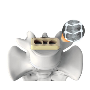 Implantes de fusión lumbar tipo V <span class=keywords><strong>Premier</strong></span> para materiales e accesorios intervencionistas de suministros médicos MOMO - Product Image 4