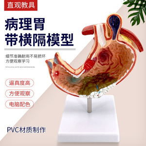 Modèle de simulation pédagogique d'estomac pathologique, modèle d'anatomie d'estomac pathologique, spécimens d'anatomie viscérale et un autre modèle. - Product Image 1