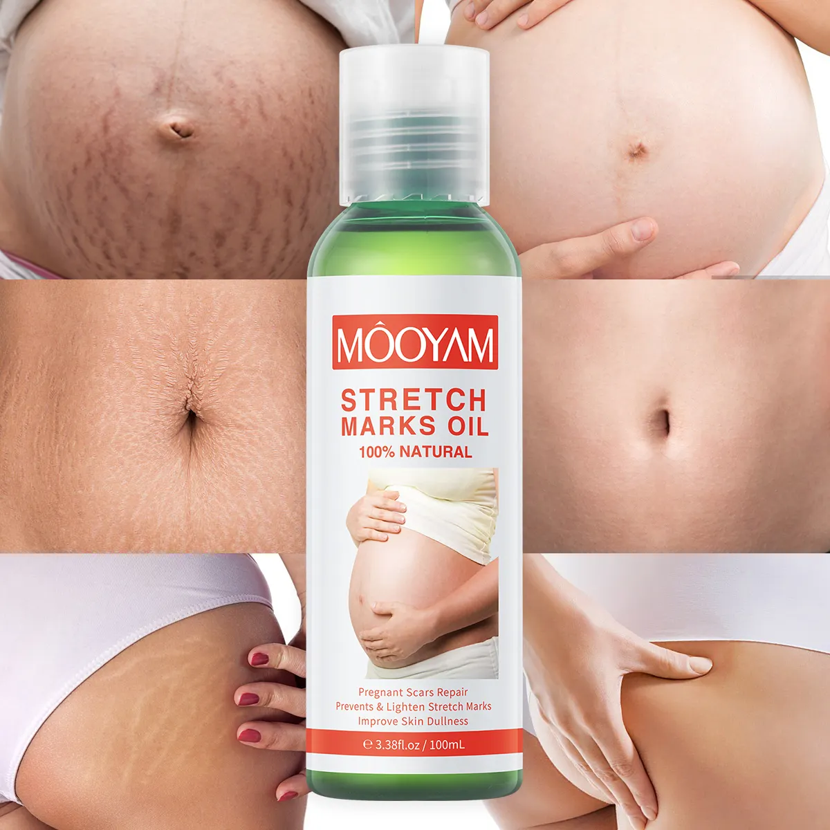 Private Label pregnancy tummy buttock abdominal acne scars,fat growth streaks lines remover,7 Days repairing stretch mark oil