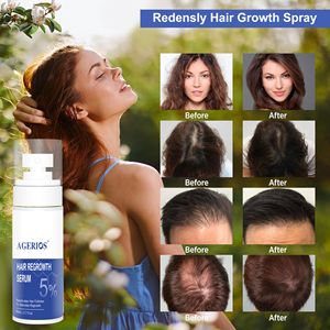 Sérum Capillaire Bloquant le DHT 5% Redensyl <span class=keywords><strong>Spray</strong></span> de Croissance Capillaire Acide Hyaluronique Stimulant à Base de Plantes Améliore la Circulation d'Oxygène Réduit la Chute des <span class=keywords><strong>Cheveux</strong></span> - Product Image 5