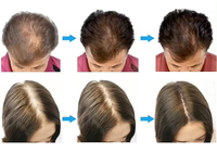 Appareil portable 5-en-1 pour l'analyse capillaire et du cuir chevelu, traitement de la perte de cheveux, massage du cuir chevelu et soins de la peau
