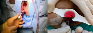 Dispositivo Láser de Doble Longitud de Onda de 980nm y 1470nm para Proctología, Hemorroides, Fisuras, Fístulas, Senos Pilonidales, PLDD, ENLT y Eliminación Vascular - Product Image 3