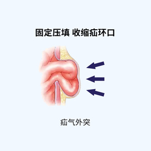 Ceinture de hernie Zhongqiang, taille unique, force moyenne, pour adultes, hernie inguinale, hernie intestinale droite ou oblique - Product Image 3