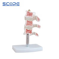 Instrumento de enseñanza de maniquí médico, simulador anatómico de esqueleto, modelo de osteoporosis humana de 3 vértebras, SC-A1022