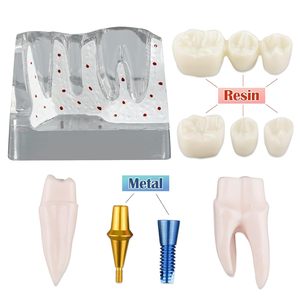 Modèle d'implant dentaire pour l'éducation des patients, modèle d'implant dentaire, de couronne et de pont 4 fois plus grand pour la présentation - Transparent - Product Image 3