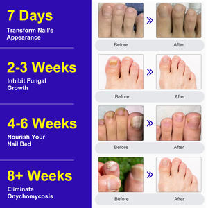 24 patchs de nuit pour ongles pour réparer et soigner les ongles et les <span class=keywords><strong>pieds</strong></span> abîmés, restaurer la décoloration et l'épaisseur MARIANP - Product Image 4