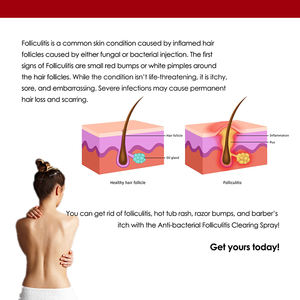 2022 Best Selling <b>Hair</b> Follicle Net <b>Spray</b> to Inhibit <b>Hair</b> Follicle Growth Good Quality - Product Image 4