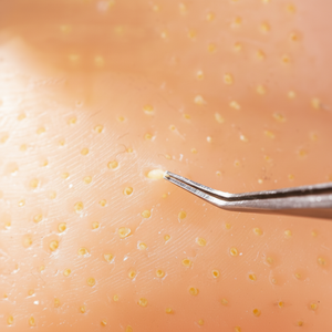 Jouet anti-stress TPR pour écraser les points noirs, pour garçons et filles de 5 à 14 ans, couleur noire - Product Image 1