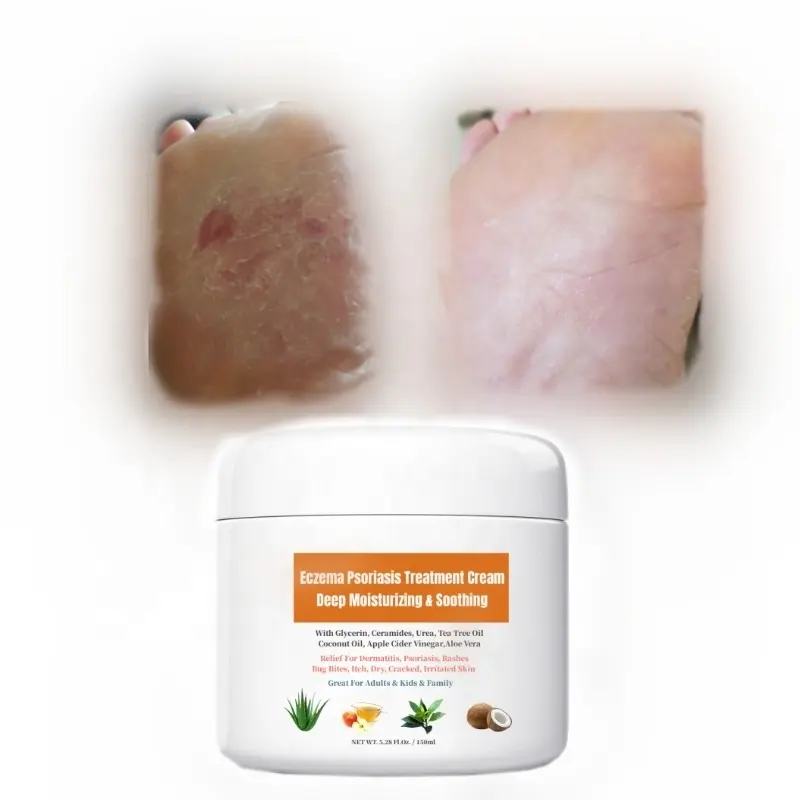 Eczema psoriasi trattamento crema idratante sollievo lenitivo per dermatiti rash morsi di insetti prurito pelle secca e screpolata