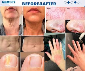 635nm 980nm1470nm फाइबर ऑप्टिक लिपोलिसिस वजन घटाने लिपो एंडो एंडोलेसर लिपोसक्शन मशीन - Product Image 5