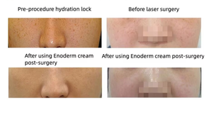 ดร. อินโนเดิร์มครีมบำรุงผิวกรดไฮยาลูรอนิกให้ความชุ่มชื้นแก่ฟื้นฟูหลังการผ่าตัดกึ่งถาวรผลิตภัณฑ์ดูแลผิวหลังการผ่าตัด K-Beauty Mild All - Product Image 4