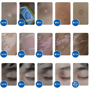 Heimgebrauch von 308 NM-Excimer-Laser zur Behandlung von Vitiligo UVB-Laser-Phototherapie Vitiligo-Excimer-Laser 308 NM Psoriasis Vitiligo Lase