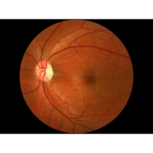 معدات مستشفى ، طب العيون ، FFA ، شبكية العين غير الميدرياتيكية - Product Image 2