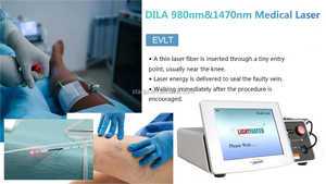 Migliore 1470 diodo 980nm Evlt <span class=keywords><strong>vene</strong></span> Varicose Laser per endovenosa ablazione termica con terapia Laser per le <span class=keywords><strong>vene</strong></span> Varicose delle gambe - Product Image 6