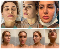 Appareil de chirurgie de liposuccion Vaser, lifting facial endolaser, laser diode chirurgical, appareil de lipolyse laser 980 nm