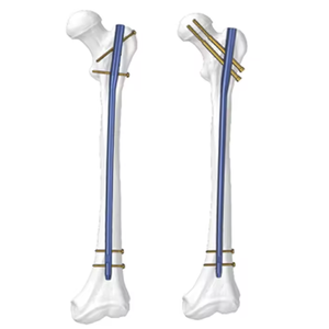 Clavo Intramedular de Bloqueo para Traumatismos de Fémur, Tibia y Húmero - Product Image 3