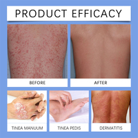 Semprotan Pereda Psoriasis Houkea Bee Venom, Semprotan Pereda Tinea Manuum Pedis, Dermatitis, Mengurangi Kemerahan, Bengkak, Melembapkan