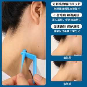 Skin Tag <b>Removal</b> Kit With Alcohol Pads For Neck And Armpits Quick Effective Treatment - Product Image 3