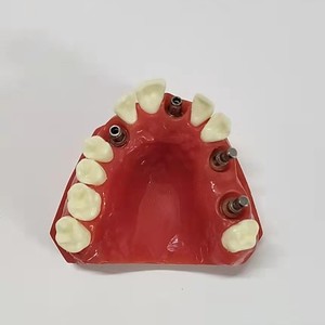 Modèle d'implant dentaire Dt 1:1, modèle anatomique en résine pour la science médicale, pour usage domestique - Product Image 1