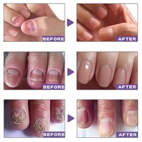 Sérum de Traitement Rapide des Mycoses des Ongles en 7 Jours OEM ODM, Huile Réparatrice pour Ongles Abîmés Marque Privée, Sérum Original pour la Croissance des Ongles