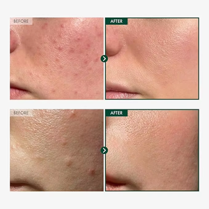 Essenza facciale della fiala della pianta della neve del Madagascar lenisce l'acne e la pelle sensibile - Product Image 4