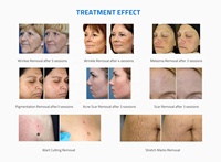 Machine à laser fractionné au CO2 10600 nm pour le blanchiment vaginal et facial, l'élimination des cicatrices, usage commercial