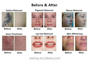 Máquina Láser <span class=keywords><strong>de</strong></span> CO2 Profesional <span class=keywords><strong>de</strong></span> Fábrica para Eliminación <span class=keywords><strong>de</strong></span> Estrías, Láser Fraccional para Eliminación <span class=keywords><strong>de</strong></span> Tatuajes, Láser Fraccional <span class=keywords><strong>de</strong></span> CO2 - Product Image 6