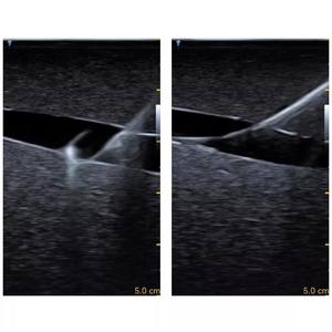 Simulador de Treinamento Médico ECMO para Treinamento de Punção de Artéria <span class=keywords><strong>Femoral</strong></span> e Veia Guiada por Ultrassom - Product Image 4
