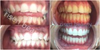 Seringue de blanchiment des dents, mélange de gel, double baril, pour effet rugueux, produits de blanchissage, 10 pièces