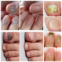 Traitement antifongique des ongles en 7 jours, spray au gingembre, solution réparatrice, nourrissante pour les ongles abîmés, huile naturelle à base de plantes pour les ongles, spray sérum