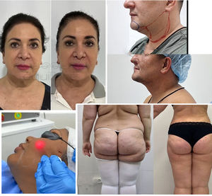 بسعر المصنع 1470 نانومتر 980 نانومتر ديود معدات الليزر إندوليزر الليزر تحلل الدهون جهاز شفط الدهون وفقدان الوزن - Product Image 6