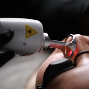 Laser Thulium sóng 1927nm điều trị nám, Laser Erbium Thulium vi điểm 1927 & 1550, Laser không vi điểm 1550 & 1927 - Product Image 2