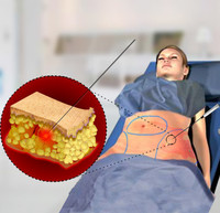 Laser diode à fibre portable 1470nm+980nm pour liposuccion chirurgicale, amincissement corporel, équipement médical de liposuccion laser