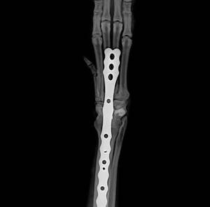 การปลูกถ่ายข้อต่อข้ออักเสบชนิดตรงของแผ่นล็อคข้อต่อข้อเข่าไทเทเนี่ยม - Product Image 2