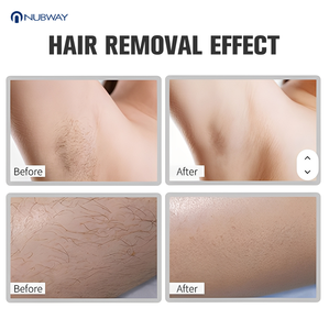 755nm 940nm 1064nm 808nm <span class=keywords><strong>Laser</strong></span> Dingin Diode Penghilang Bulu <span class=keywords><strong>Laser</strong></span> Depilatori Peralatan Klinik untuk Semua Warna Kulit - Product Image 5