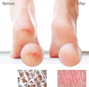 Lime à <span class=keywords><strong>pieds</strong></span> en verre Sunivaca, éliminateur de callosités, grattoir pour talons, exfoliant pour <span class=keywords><strong>pieds</strong></span> diabétiques, éliminateur de peaux mortes, outils de pédicure professionnels - Product Image 4