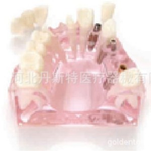 Modèle d'implant dentaire Dt M2008, modèle anatomique en silicone médical pour l'enseignement des sciences médicales - Product Image 2
