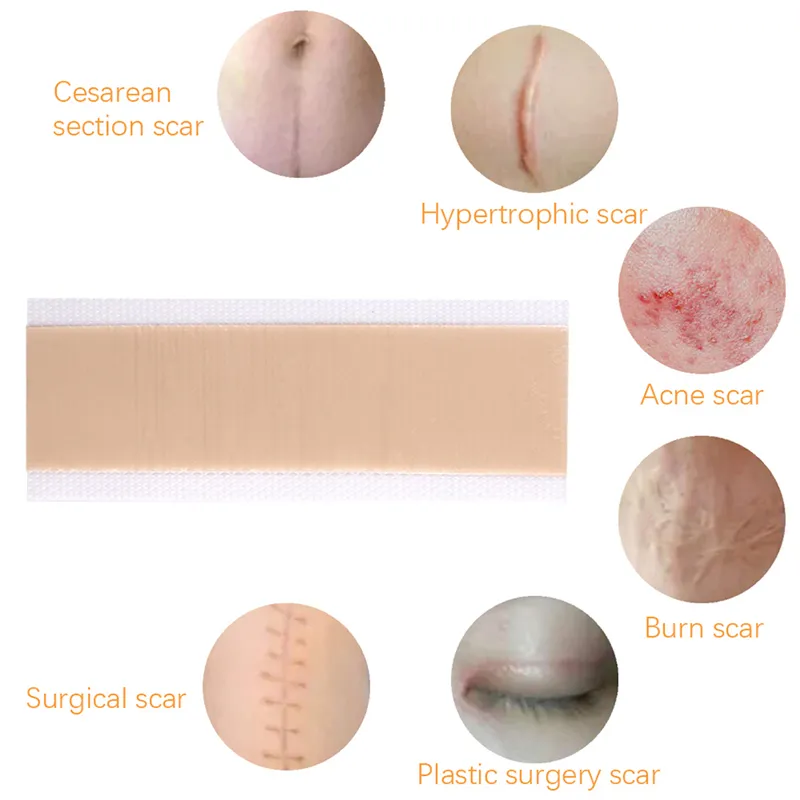 Best Selling Silicone Gel Scar Dressing Advanced Waterproof Scar Away Treatment Large Silicone Scar Gel Sheet Patch