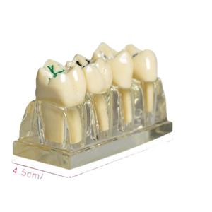 Modelo de Sellador de Fisuras Dentales Transparente para Niños, para la Prevención de Caries, Procedimiento de Obturación Dental, Accesorio de Equipo de Terapia Oral - Product Image 5